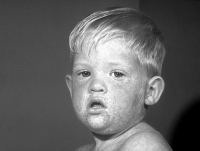The face of a boy with measles. This is the third day of the rash.